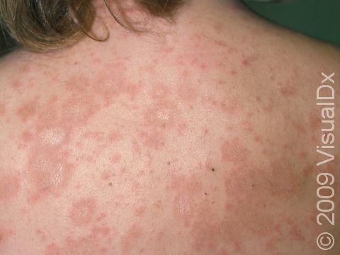This image displays a rash with slight scaling that is typical of pityriasis rosea.