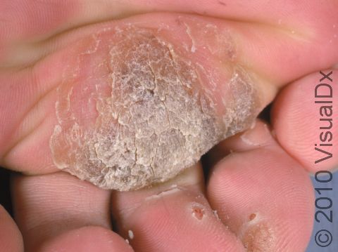 This image displays a close-up of a plantar wart showing the thick, callous-like surface due to thickening of the outer-most skin layers.