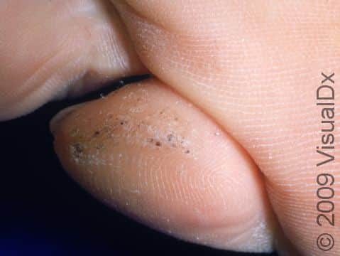 This image displays a typical plantar wart with clotted capillaries appearing as small, black dots on the skin.