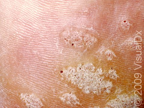 This image displays a close-up of plantar warts (warts on the feet) with black and red 