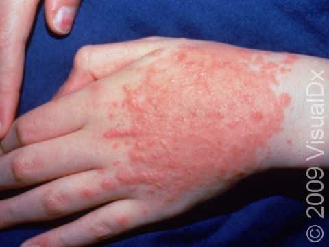 The linear streaks seen near the third finger are characteristic of allergic contact dermatitis from a plant - in this case poison ivy.