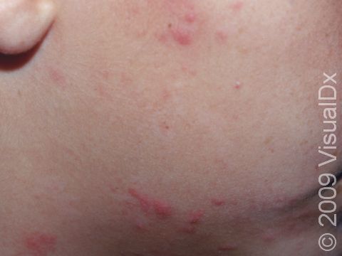 The irregular bumps of early poison ivy dermatitis may resemble acne when on the face.