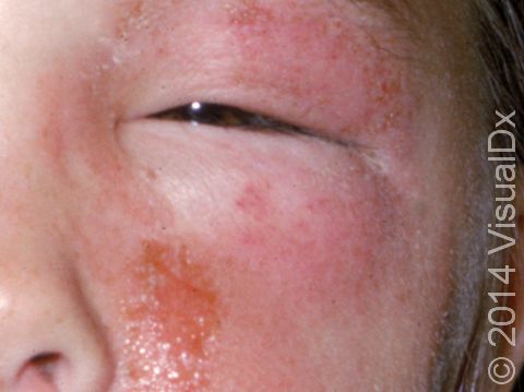 Poison ivy often causes facial swelling and 
