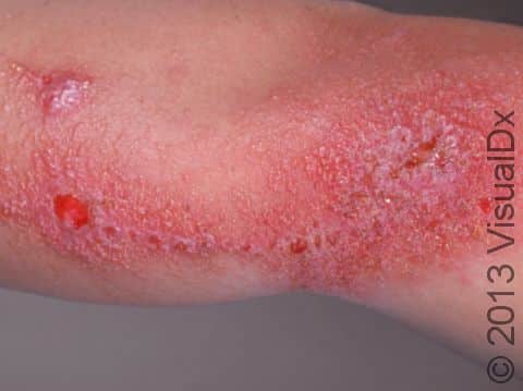 This image displays broad areas of inflammation with a linear pattern typical of poison ivy or poison oak.