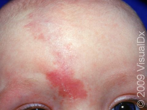 This is a three-month-old infant with a port-wine stain.