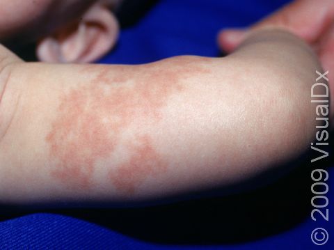 Port-wine stains are persistent vascular malformations, as seen here on the arm.