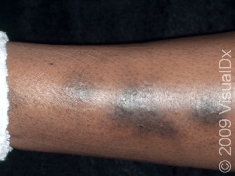 Postinflammatory hyperpigmentation may look almost purple-brown in darker-skinned individuals and take months to fade on the lower legs.