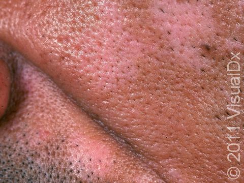 This patient had a rash that resulted in pigment loss typical of post-inflammatory hypopigmentation.