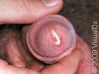 Gonorrhea, Primary Infection