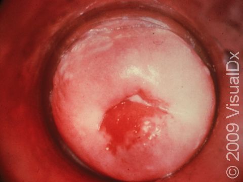 This is a close-up view of the cervix (the mouth of the womb), inside the vagina of a woman with gonorrhea. There is redness and a slight white discharge at the womb opening.