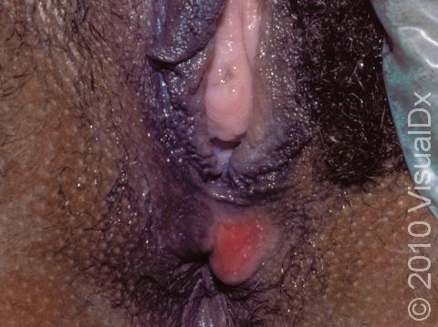 This image displays a painless ulcer with a red base, typical of primary syphilis.