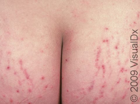 Multiple small scabs are seen on the buttocks from scratching the lesions of PUPPP. Some of the lesions are seen in stretch marks here.