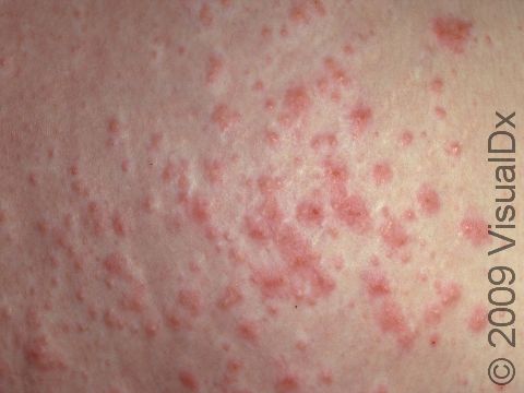 The numerous red bumps of PEP sometimes look like hives and are intensely itchy.