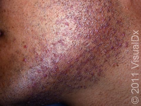 Pseudofolliculitis barbae is a condition where ingrown beard hairs cause irritation and inflammation; it commonly affects African American men.