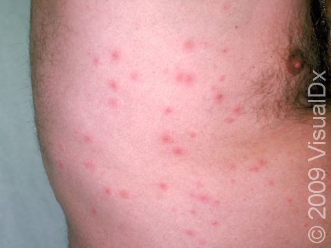 This image displays follicular elevations of the skin and small pus-filled lesions.