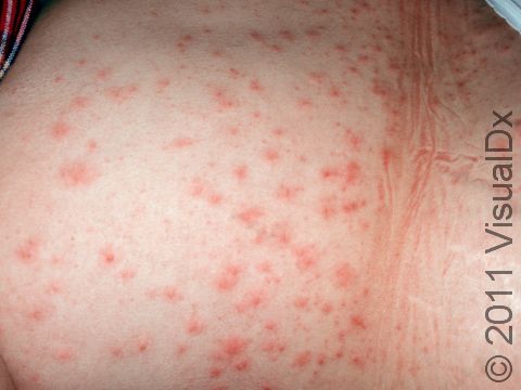 In pseudomonas folliculitis (hot tub folliculitis), the red skin lesions are often quite large, as displayed in this image.
