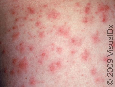 This image displays a close-up of the typical red bumps of pseudomonas folliculitis (hot tub folliculitis).