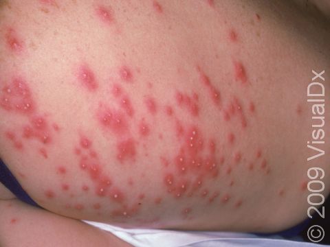 This image displays a severe case of pseudomonas folliculitis (hot tub folliculitis).