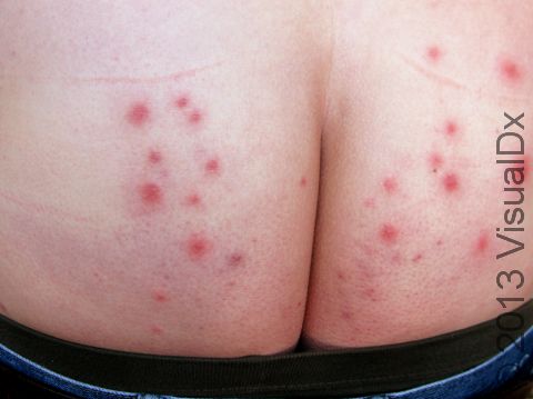 Hot tub folliculitis occurs on skin that was covered by one's bathing suit after being in a hot tub or spa. The spots often go away after several days, without any treatment. This image shows spots in a person who was in a hot tub 4 days prior.