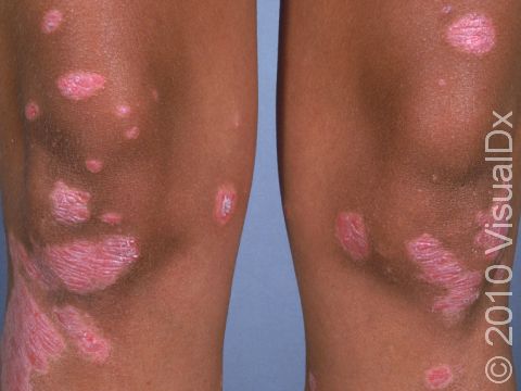 Psoriasis typically has multiple areas of skin involvement with lesions clustered on or near the knees.