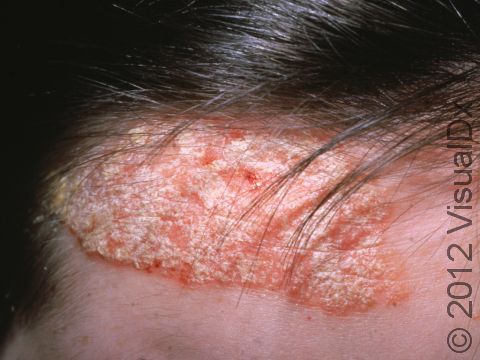 Redness and silver-looking scaling often affect the scalp and hairline with psoriasis.