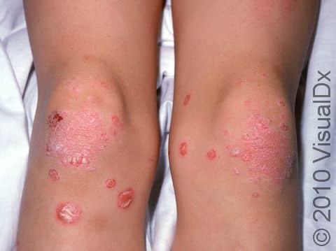 Psoriasis can be displayed as smaller, scattered patches.