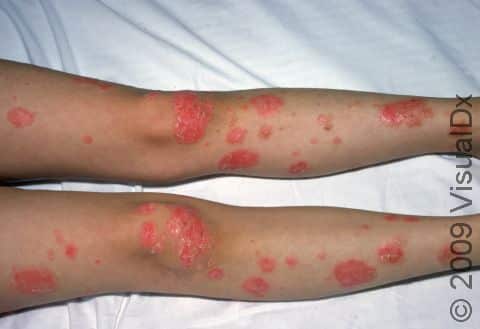 Redness and thick scaling of the slightly elevated lesions is common with psoriasis.