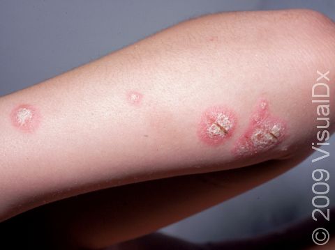 This image displays typical slightly elevation lesions of psoriasis with thick, white scale and redness.