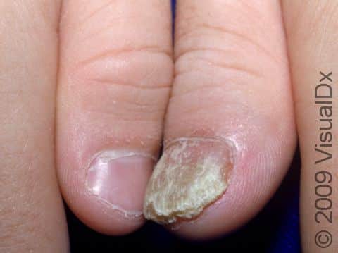 This image displays the contrast between a nail affected by psoriasis (on the right) and one that is normal (on the left).