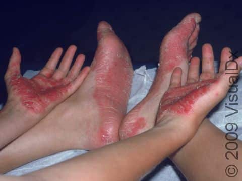 This image displays psoriasis that affects only the patient's palms and soles (palmoplantar psoriasis).