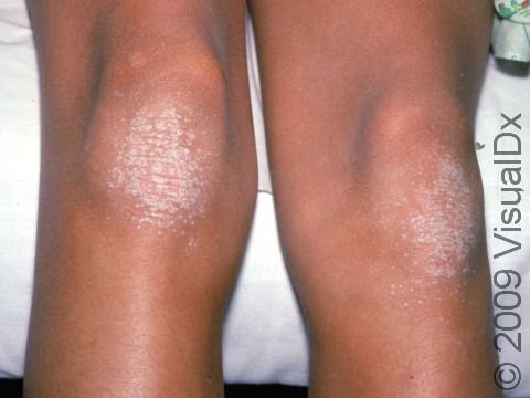 This image displays knees affected by psoriasis.