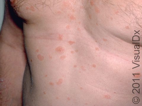 Psoriasis can also present with multiple smaller lesions that are widely distributed on the body.