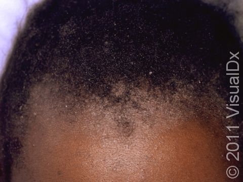 This image displays dry, scaly areas of the scalp typical of psoriasis.