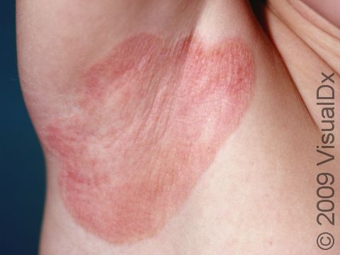 This image displays a large, red, scaly, slightly elevated lesion of psoriasis in the armpit.