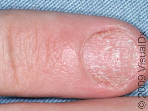 This image displays a nail affected with psoriasis.