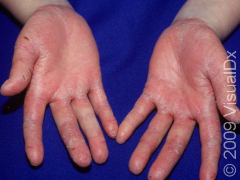 This image displays cracks in the skin of hands typical of psoriasis.
