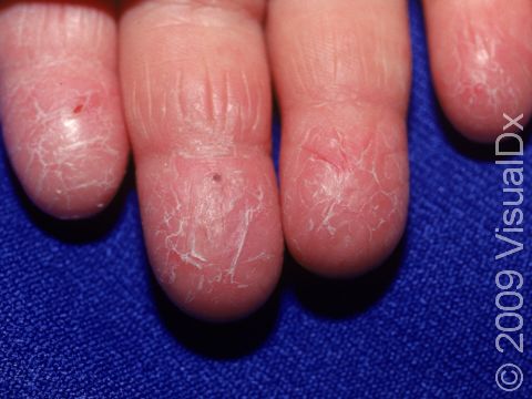 This image displays dry, cracked skin typical of psoriasis.