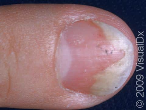 This image displays small pits and discoloration of the nail surface typical of psoriasis of the nail.