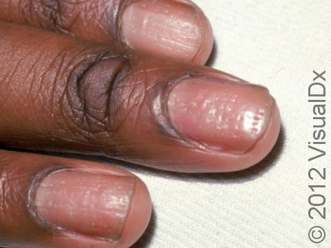 Psoriasis may be evident in the nails with multiple tiny, pit-like depressions of the nail plate surface.