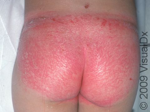 Psoriasis frequently is more severe on the buttocks.