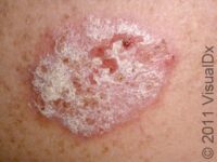 5 Questions You Have about Psoriasis Answered