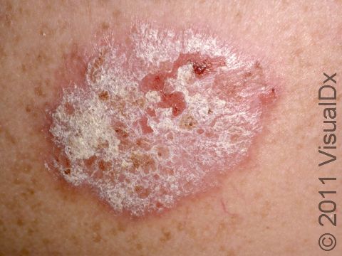 Psoriasis often has white, thick scale that comes off in 