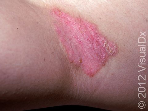 When psoriasis involves body fold areas (known as psoriasis inversus), there is not as much scaling due to moisture.