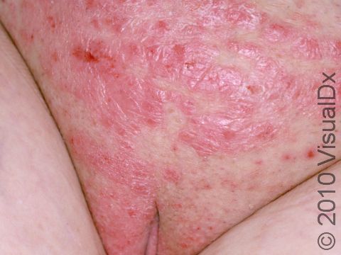 Psoriasis frequently occurs in the genital area of men and women. Psoriasis is not contagious and is not spread sexually.