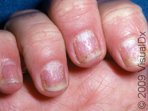 In addition to pitting of the nail surface, this patient with psoriasis has a yellowish discoloration and separation of the nail plate from the nail bed (onycholysis) of the free edges of the nails.