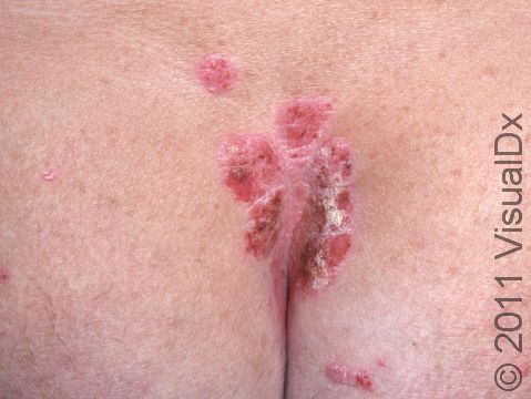 The sacral and buttocks cleft is a very common location for psoriasis.