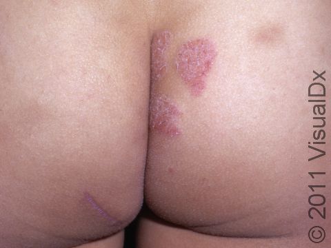 The buttocks are a common location for psoriasis.