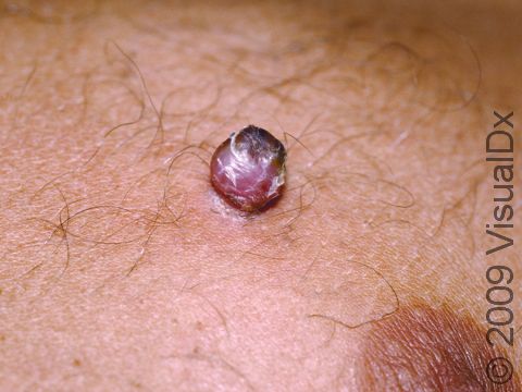 This image displays the elevation of skin typical of pyogenic granuloma, with a crust due to discharge of blood.