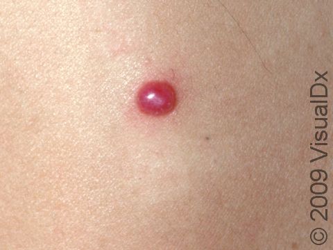 This image displays the deep red color typical of pyogenic granulomas.