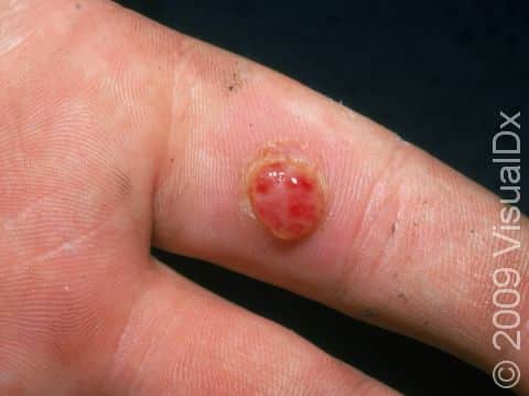 The fingers are a common location for pyogenic granulomas.